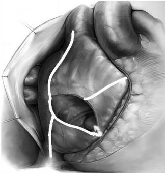 Comparison of short-term efficacy of two bipolar radiofrequency ablation forceps for rheumatic heart disease concomitant with atrial fibrillation